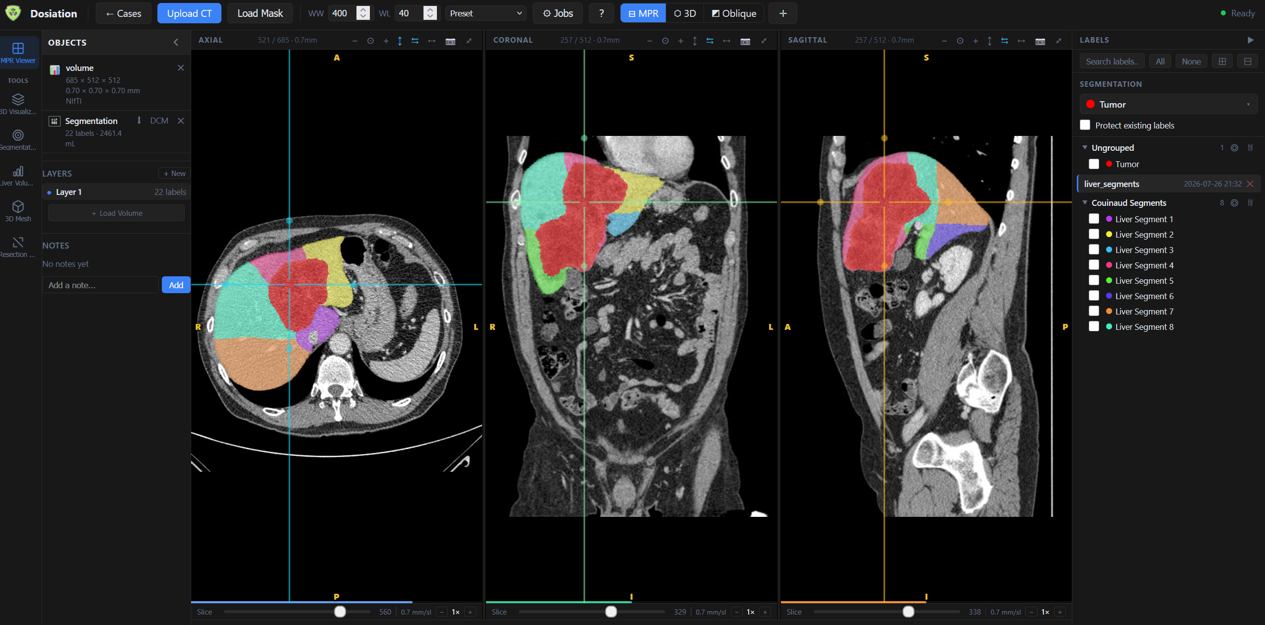 Axial, coronal and sagittal views showing all 8 Couinaud liver segments in color-coded fill mode